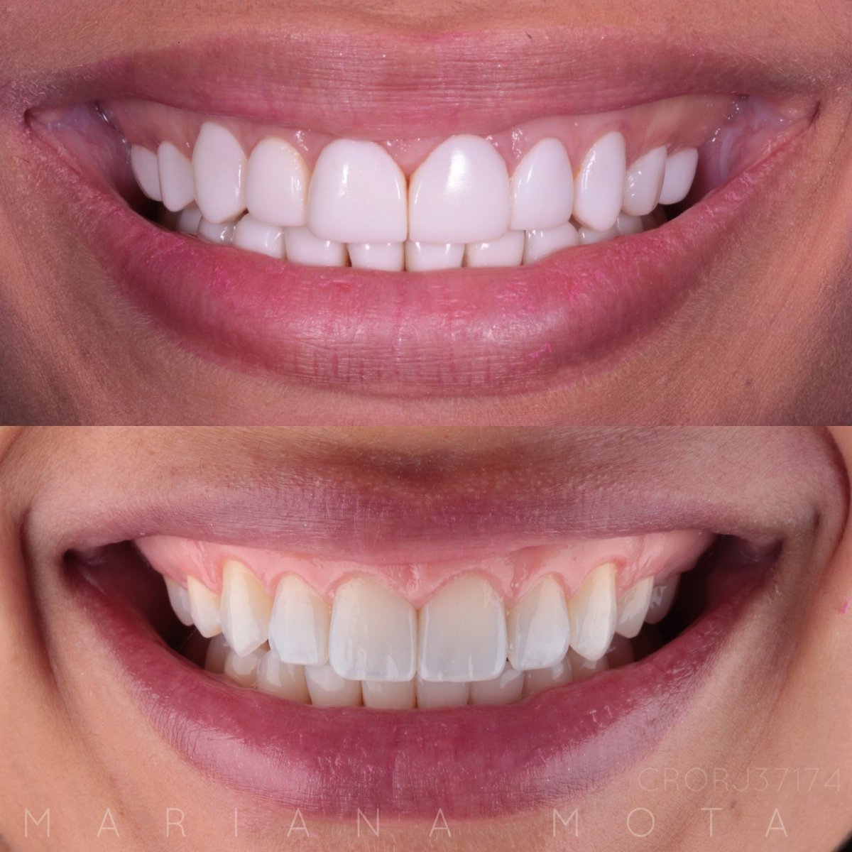Resultados antes y después de carillas dentales – sonrisa más blanca y uniforme