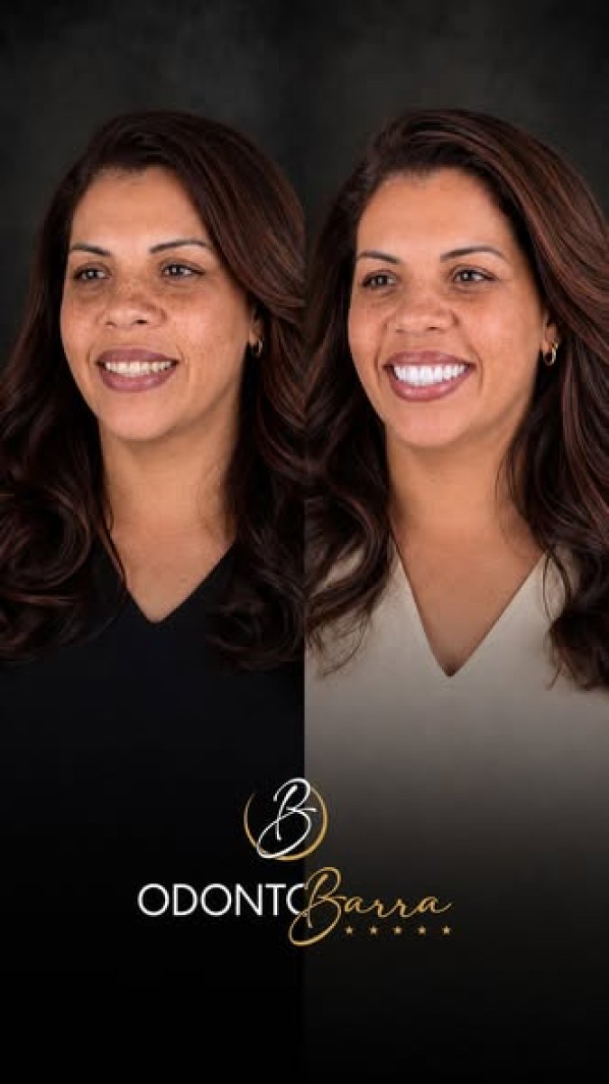 Resultados de antes y después de Invisalign en OdontoBarra – sonrisa y alineación mejoradas