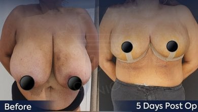 before-after photo umensenie-grudi
