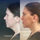 Before and after deep plane facelift results at Dr. Safa Manav Clinic, visible jawline lift
