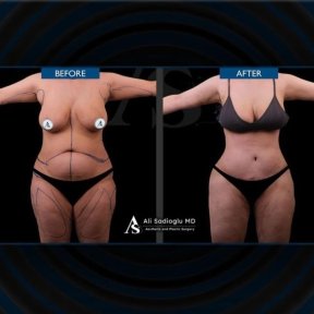 Before and after tummy tuck results at Dr. Safa Manav Clinic, visible abdominal contouring