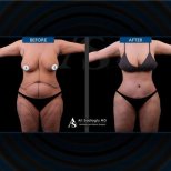 Before and after tummy tuck results at Dr. Safa Manav Clinic, visible abdominal contouring