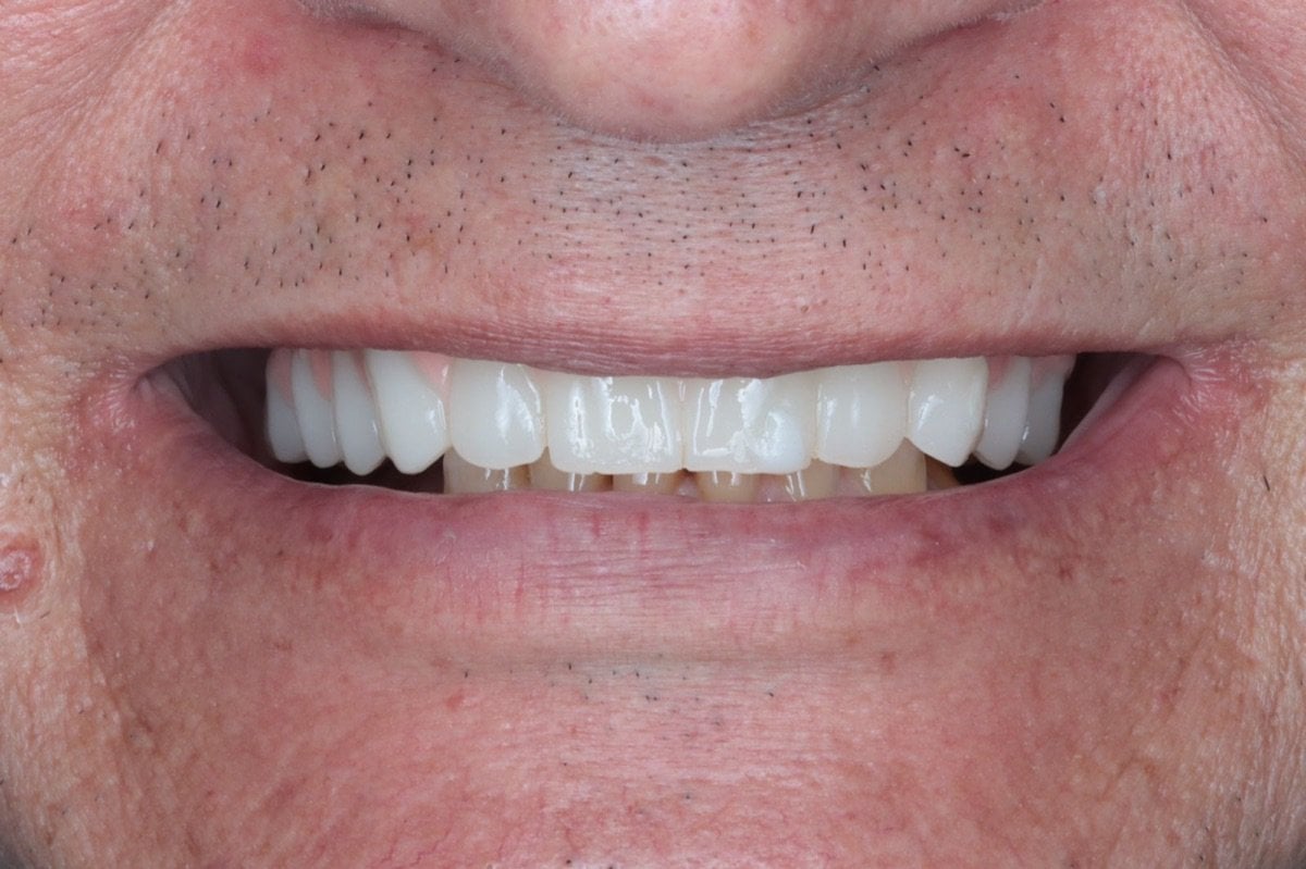 before-after photo
