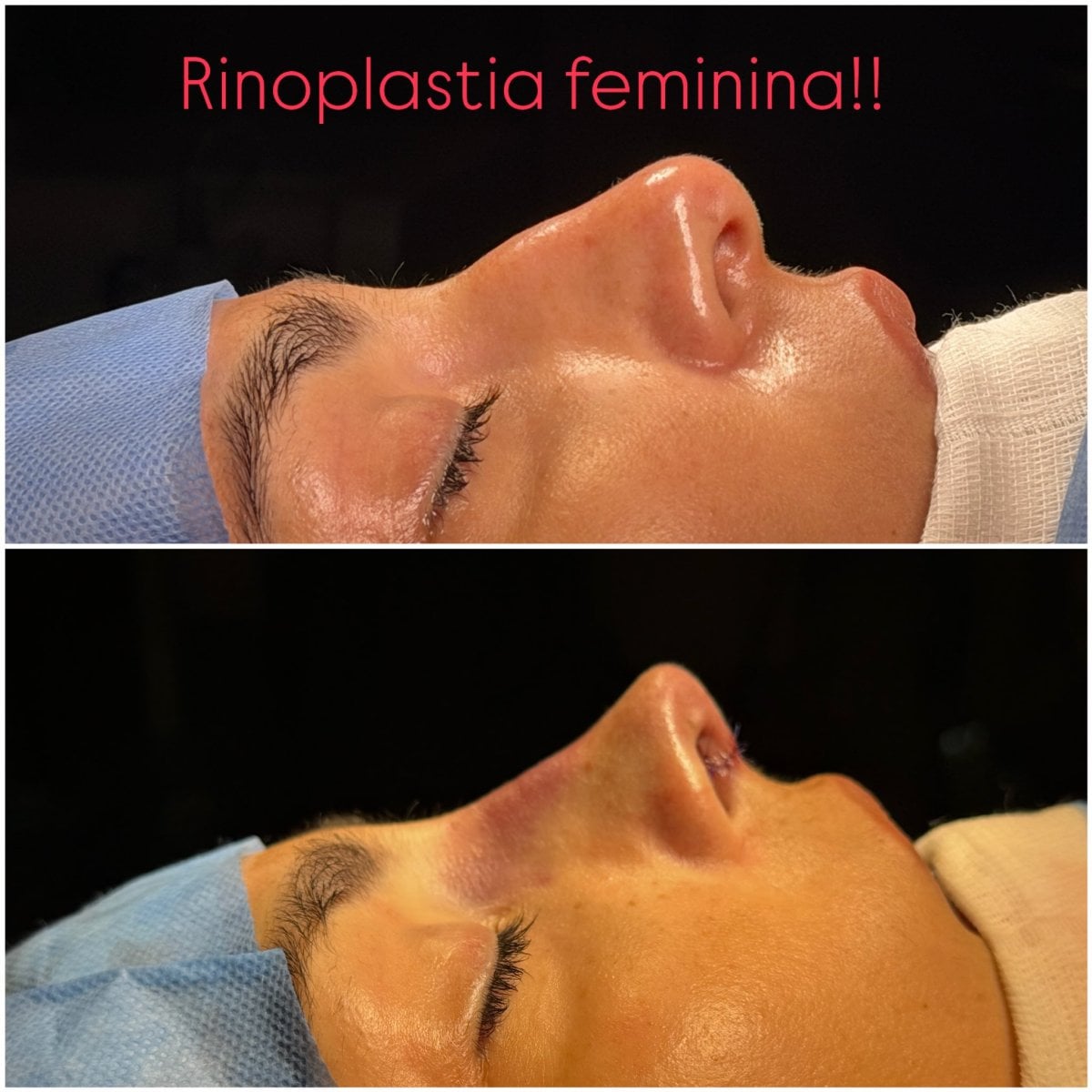 نتائج تجميل الأنف للنساء قبل وبعد – تحسين شكل الأنف والملف الجانبي