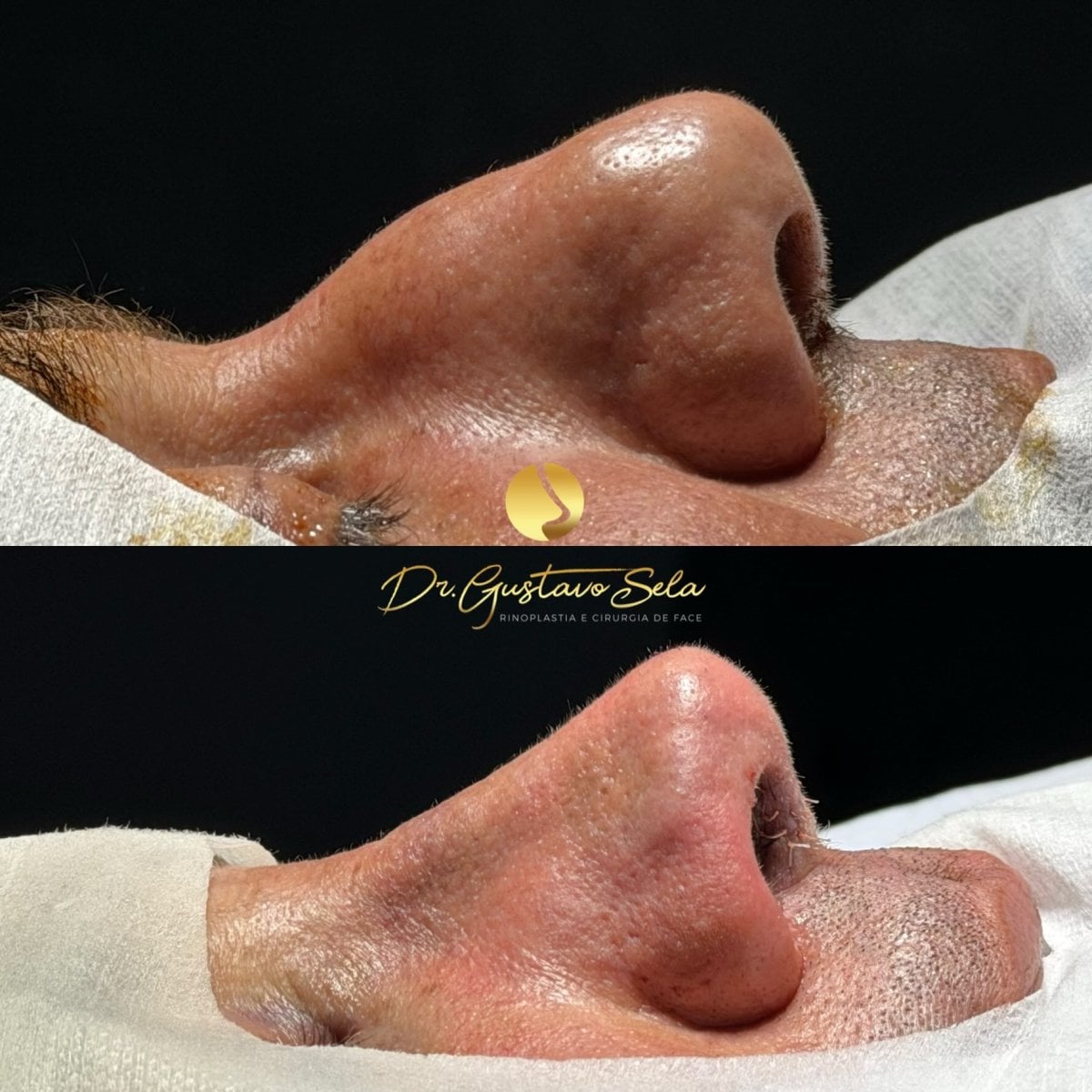 Resultados de rinoplastia antes y después en la clínica Dr. Gustavo Sela, mejora nasal