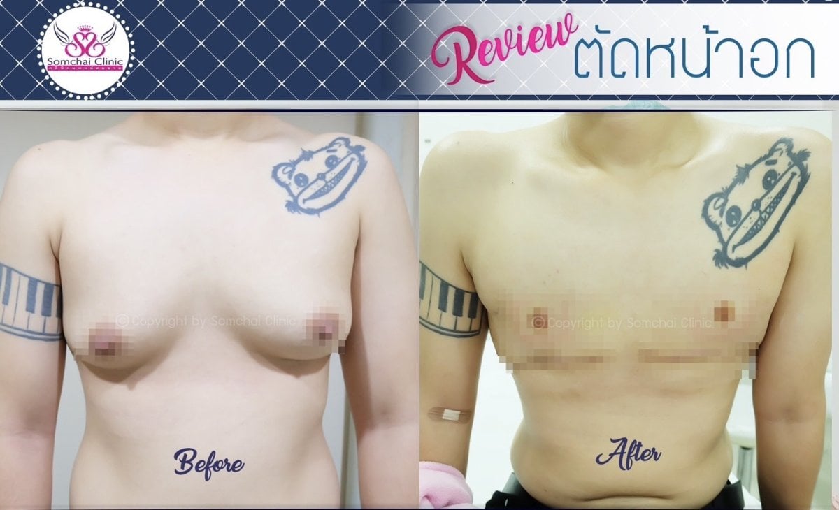 Resultados antes y después de reducción de senos en Somchai Clinic – mejora del contorno