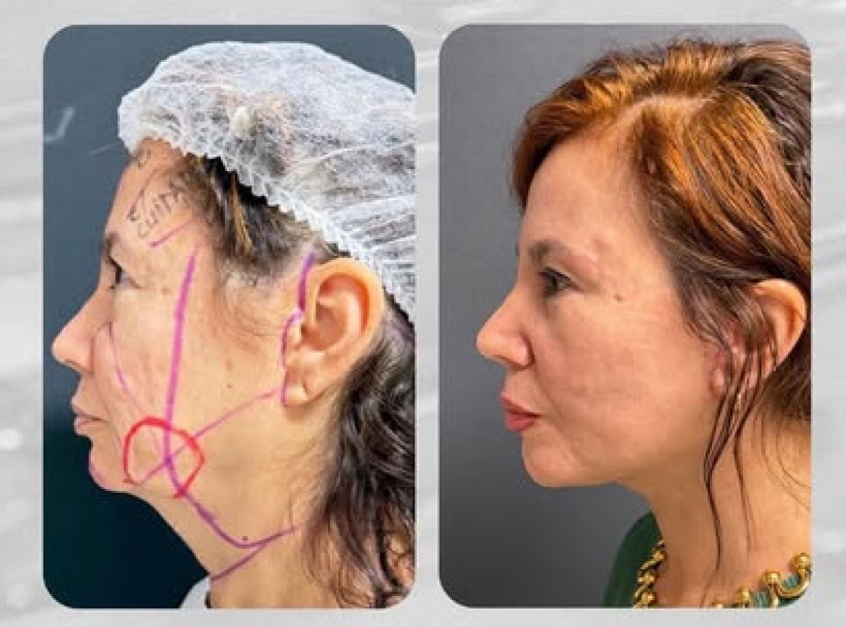 Resultados de lifting facial antes y después – rejuvenecimiento y mandíbula definida