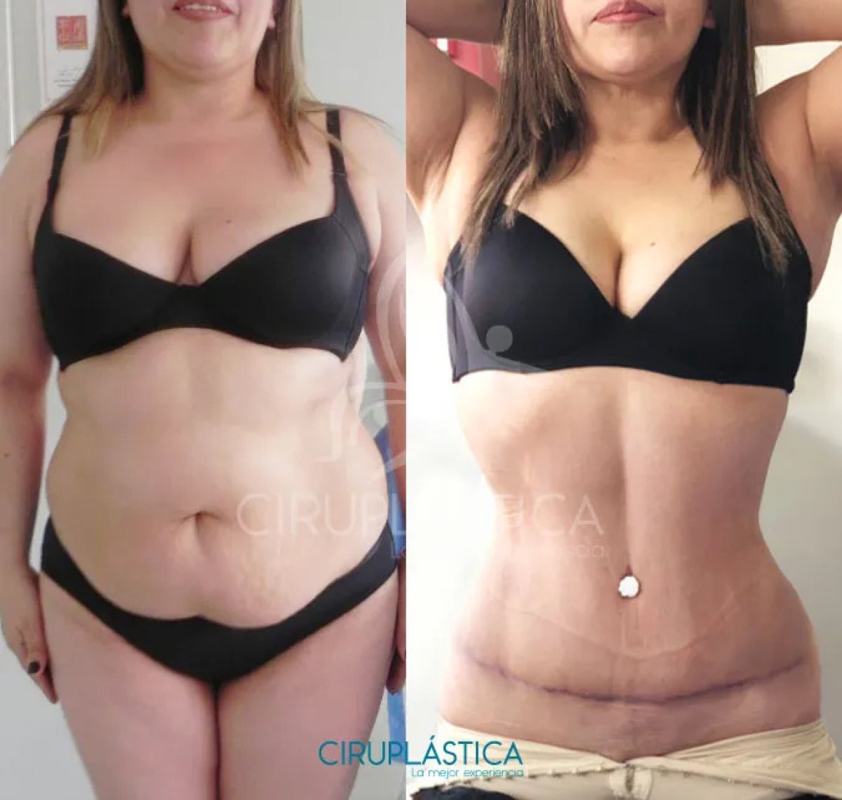 Resultados de abdominoplastia antes y después en Ciruplástica – mejora del contorno abdominal