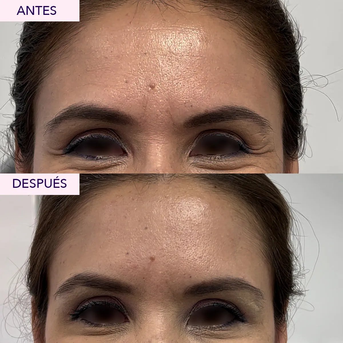 Resultados antes y después de inyecciones de bótox – frente más lisa y menos arrugas