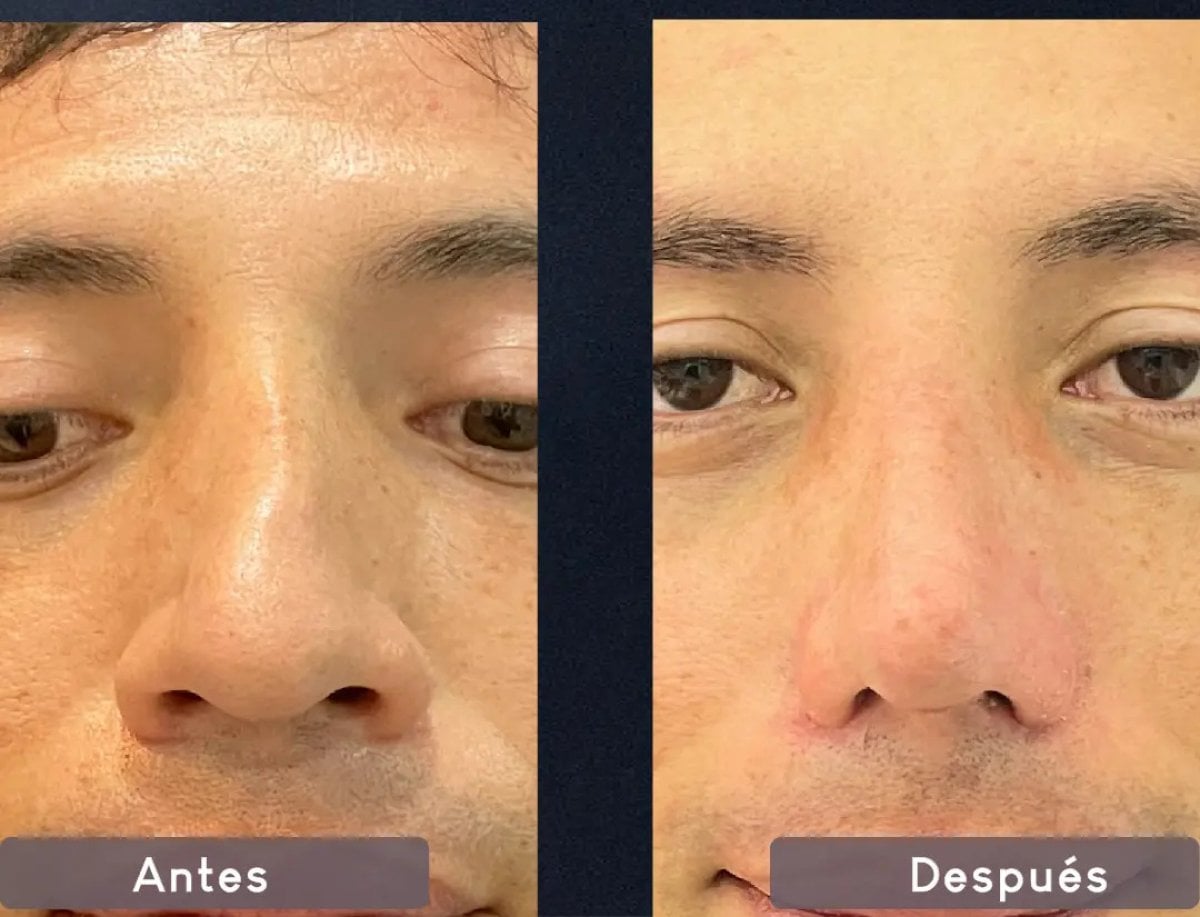 Resultados antes y después de rinoplastia ultrasónica, remodelación visible de la nariz