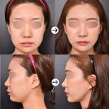Before and after chin liposuction results at VG Plastic Surgery, improved jawline contour