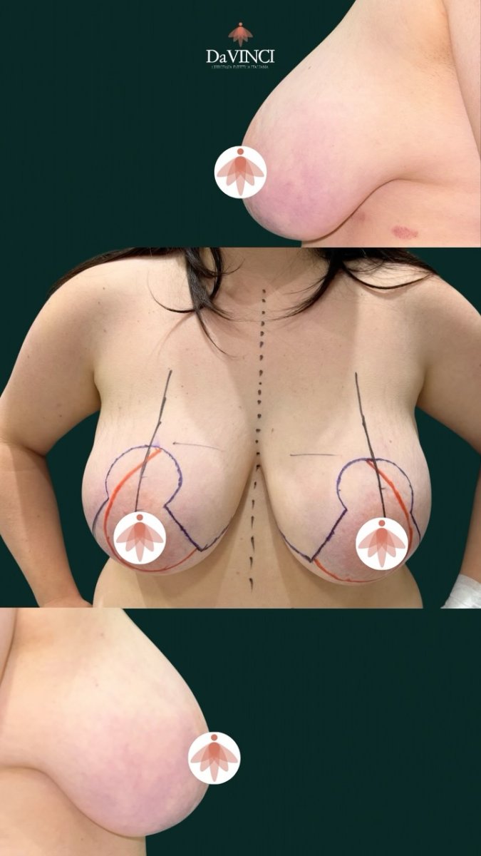 Resultados de mamoplastia antes y después en DaVinci Clinic – elevación y remodelación visibles