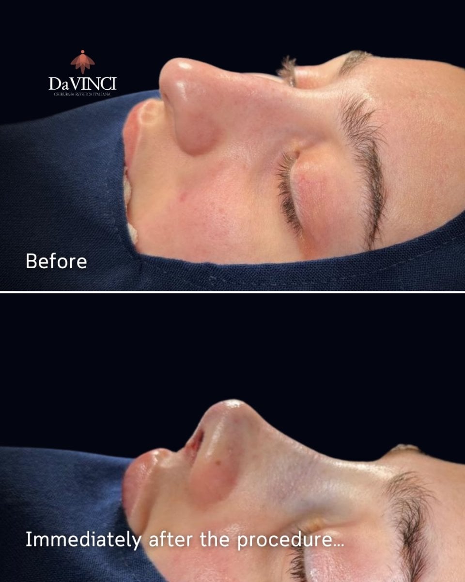 نتائج عملية تجميل الأنف قبل وبعد في عيادة DaVINCI، إعادة تشكيل الأنف بشكل طبيعي