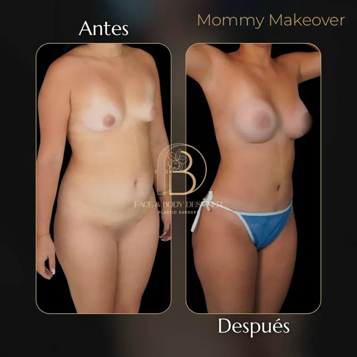 نتائج قبل وبعد لمامي ميك أوفر في Face & Body Designer – تحسين شكل الجسم