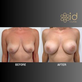 before-after photo breast-implants-with-breast-lift