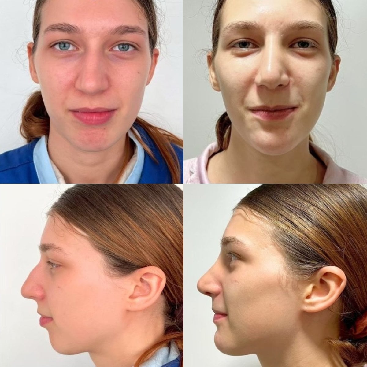 Resultados antes y después de tip rinoplastia en ID Clinic Bangkok, mejora de forma y perfil nasal