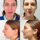 Результаты до и после ринотипопластики в ID Clinic Bangkok, улучшена форма носа и профиль