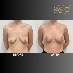 Before and after breast lift results at ID Clinic Bangkok, improved breast shape and contour