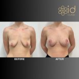 Before and after breast lift results at ID Clinic Bangkok, improved breast shape and contour
