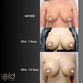 Breast lift before and after results at ID Clinic Bangkok, visible improvement after 14 days