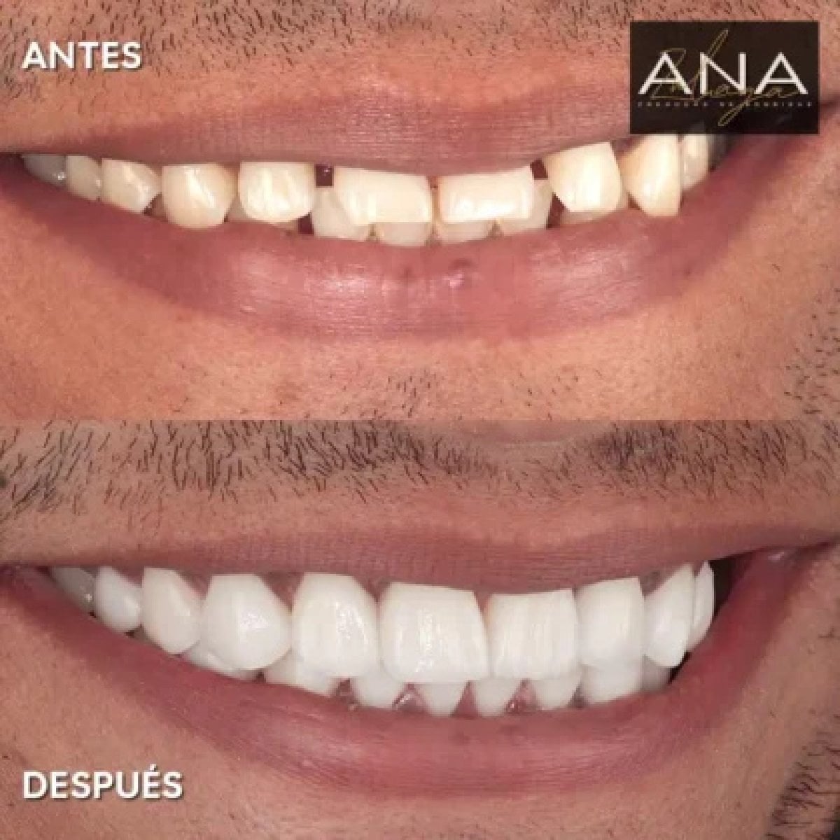 نتائج تبييض الأسنان قبل وبعد في عيادة ANA – ابتسامة أكثر بياضاً وإشراقاً