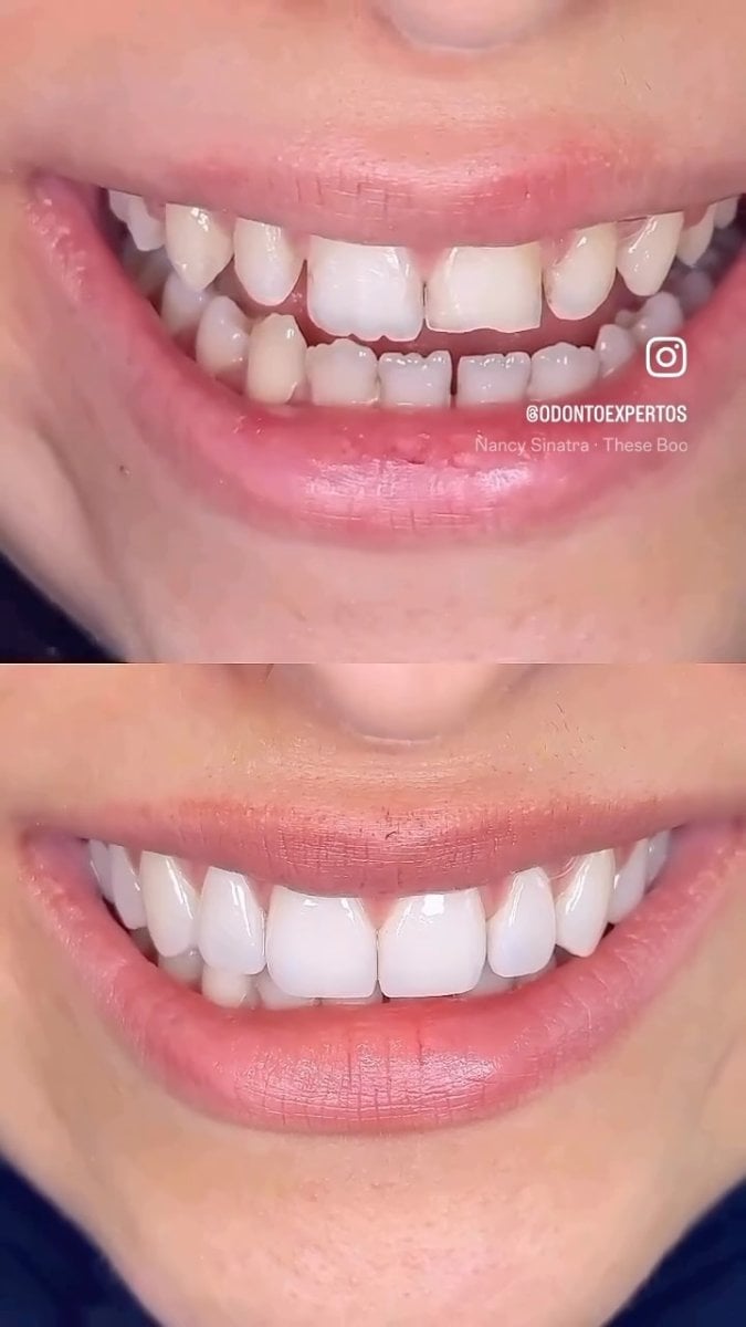 نتائج تبييض الأسنان قبل وبعد في ODONTOEXPERTOS – ابتسامة أكثر إشراقًا بوضوح
