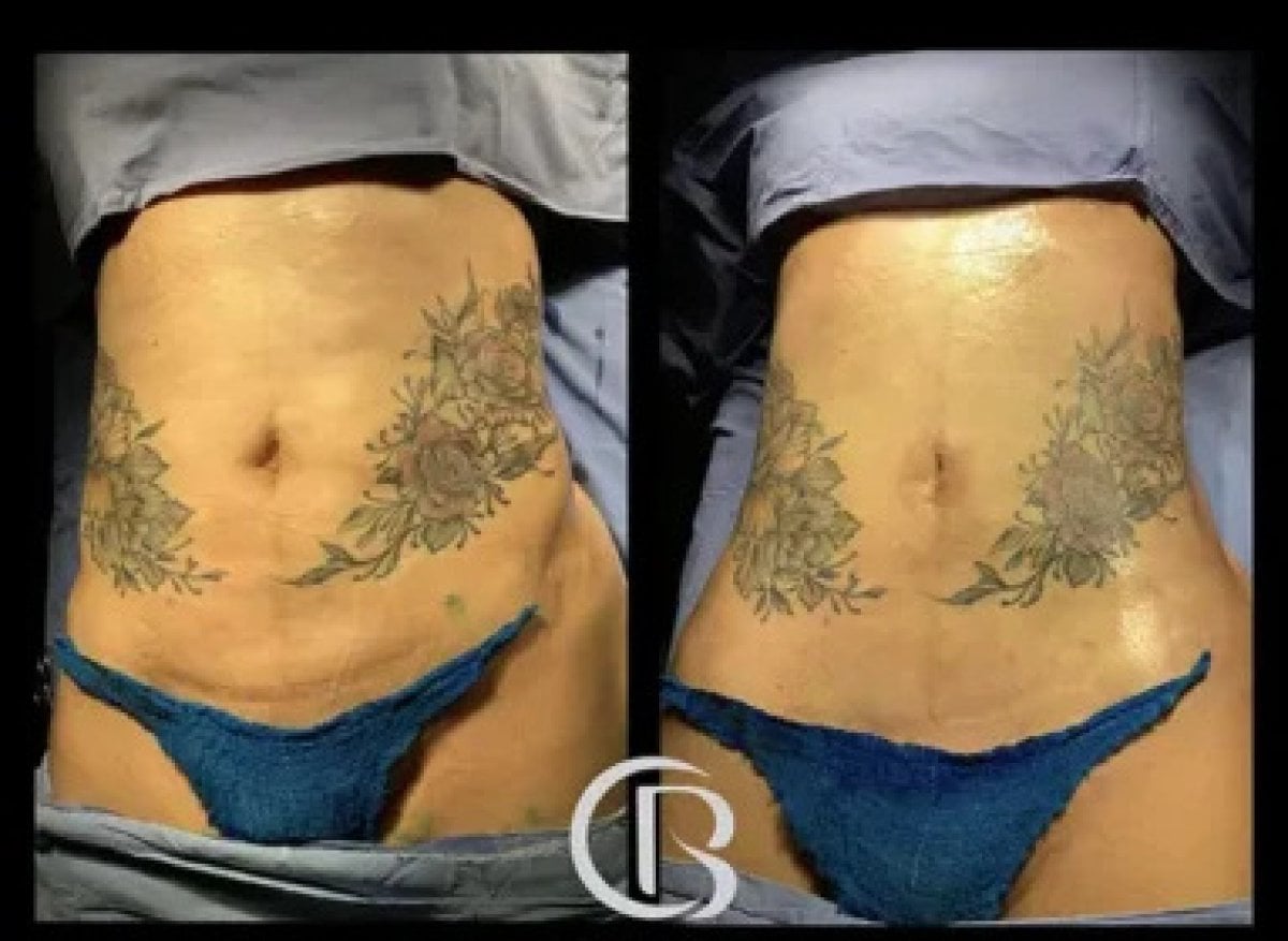 before-after photo