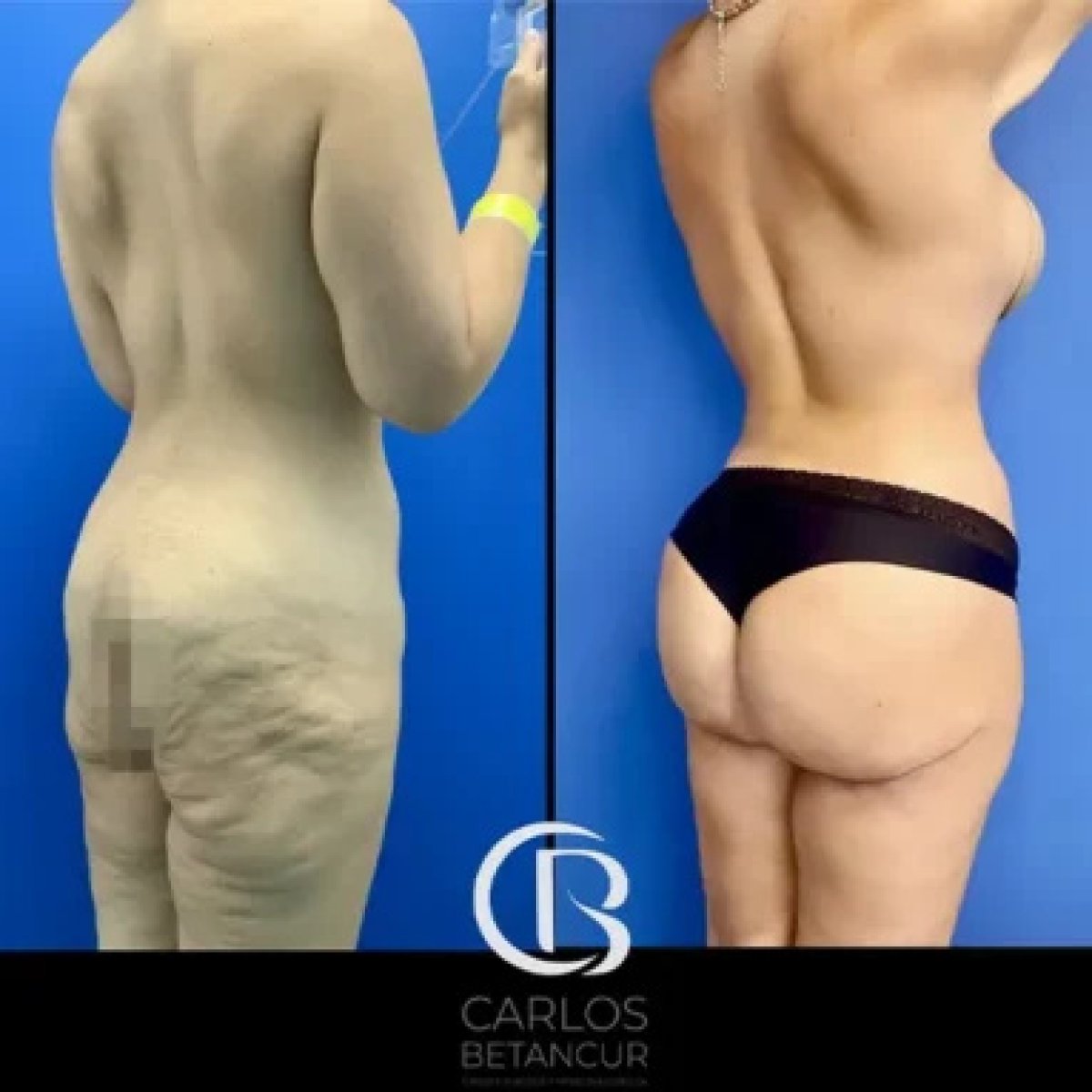 before-after photo