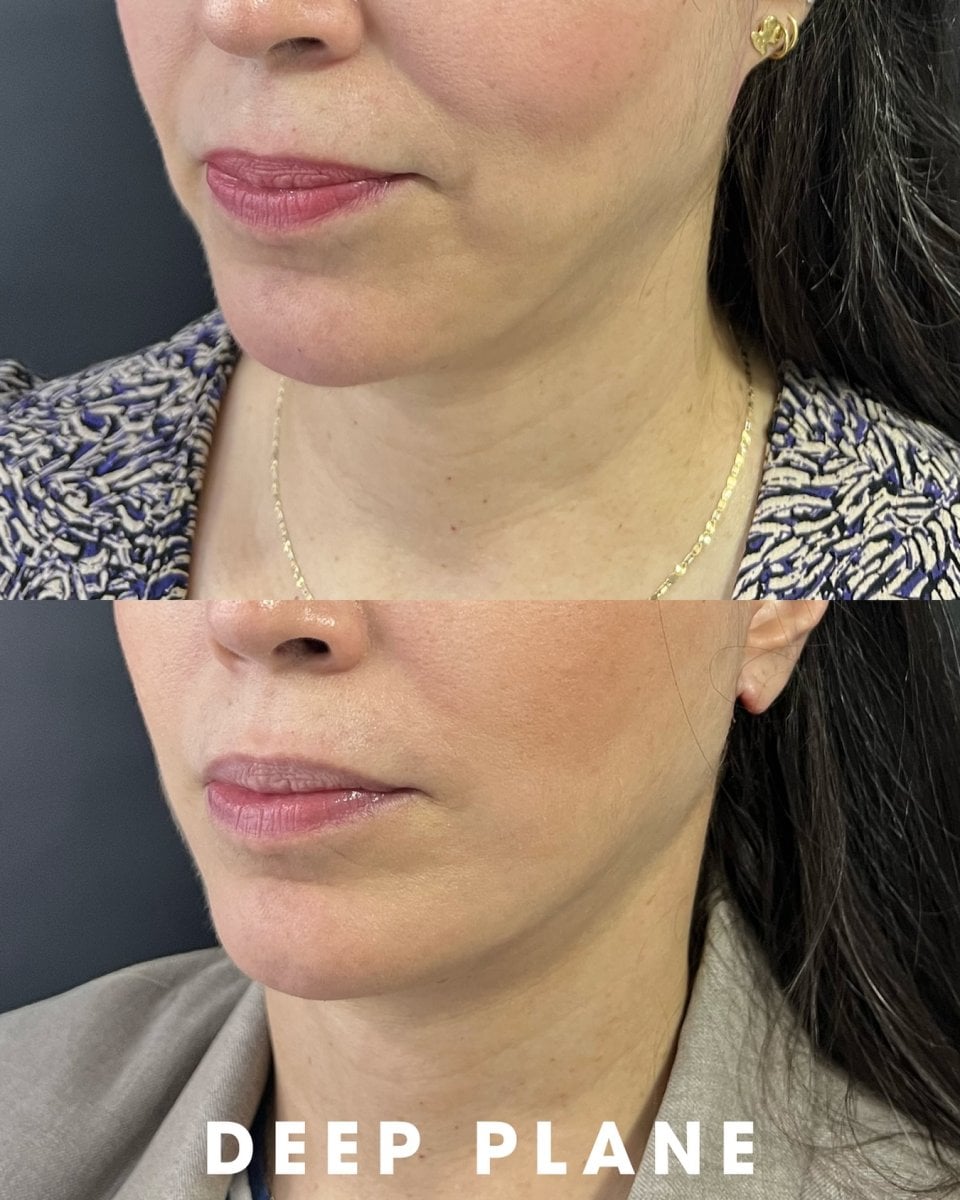 before-after photo