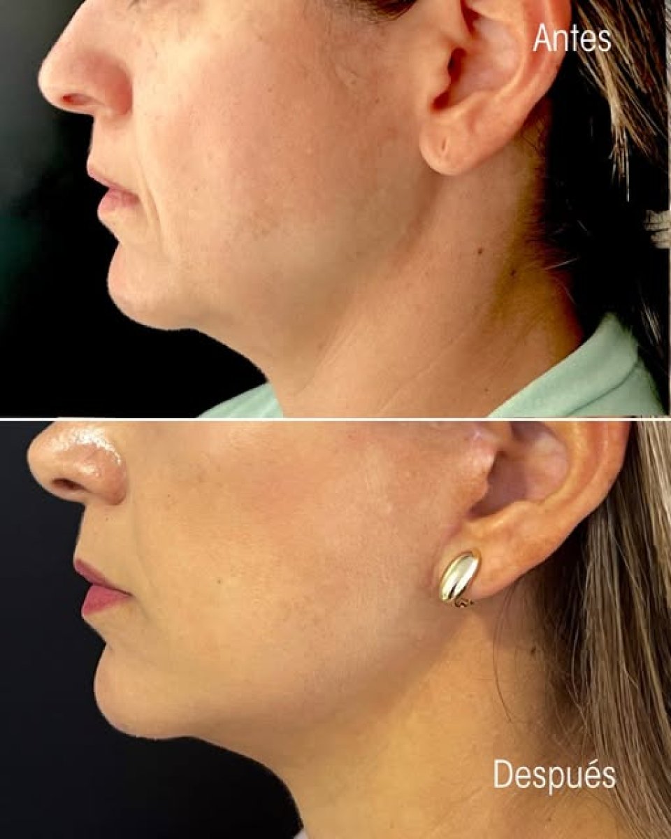 before-after photo
