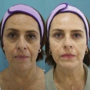 before-after photo botox-injections