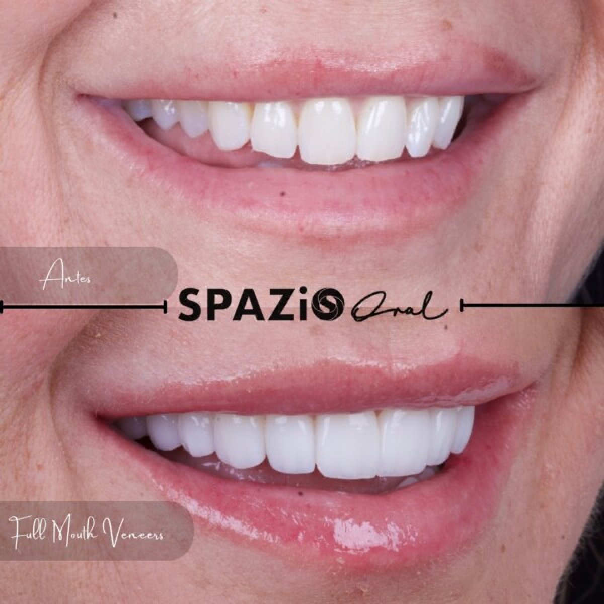 Resultados antes y después de carillas de composite en Spazio Oral – transformación total de sonrisa