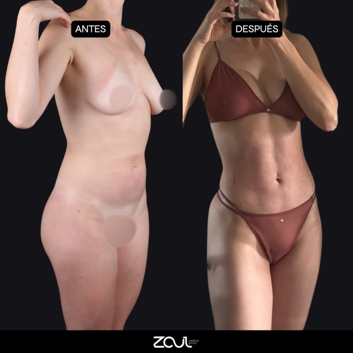 نتائج قبل وبعد تجميل الأمومة في Zaul Medical Clinic – تحسين شكل الجسم
