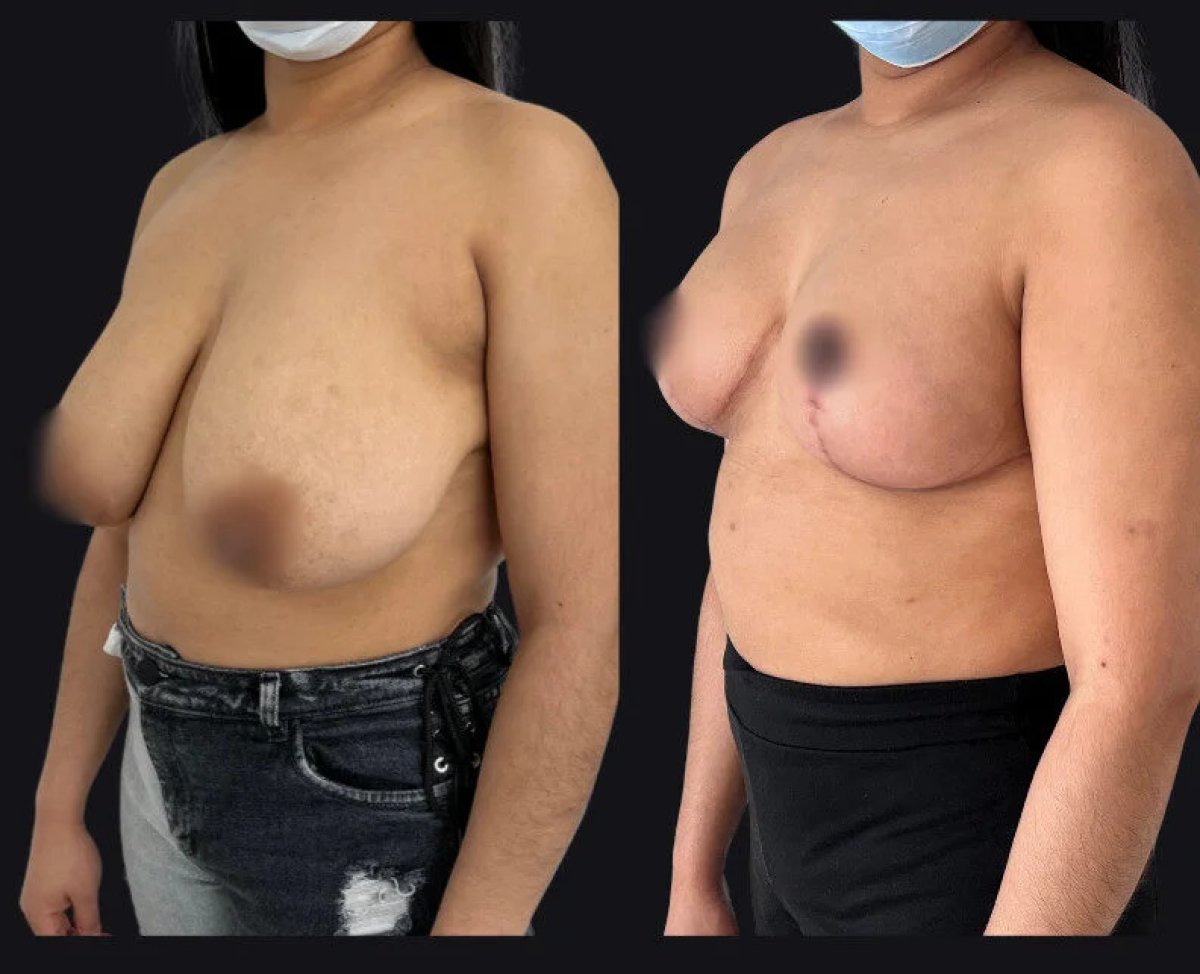 before-after photo