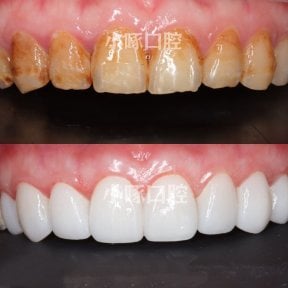 before-after photo installation-of-a-veneer