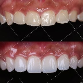 before-after photo installation-of-a-veneer