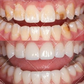 before-after photo installation-of-a-veneer