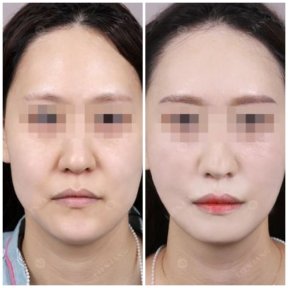 before-after photo double-chin-liposuction