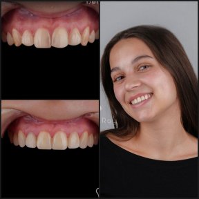 before-after photo installation-of-a-veneer