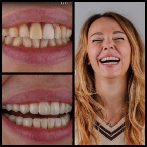 before-after photo installation-of-a-veneer