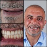 Before and after zygomatic implant results at Dentaray Clinic – restored full smile