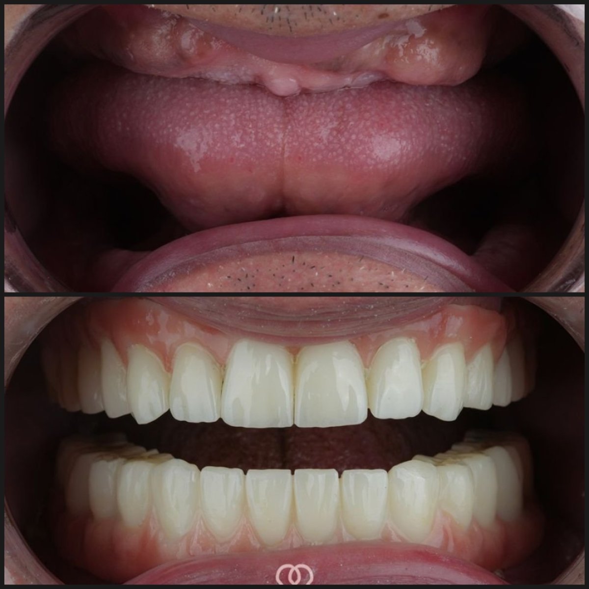Resultados antes y después de implantes cigomáticos en Dentaray Clinic – restauración dental total