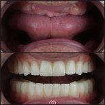 Результаты до и после зигоматических имплантов в Dentaray Clinic – полная реставрация зубов