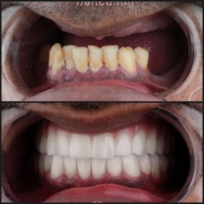Результаты до и после зигоматических имплантов в Dentaray Clinic – восстановление улыбки
