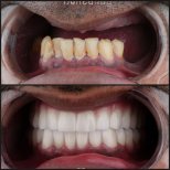 Результаты до и после зигоматических имплантов в Dentaray Clinic – восстановление улыбки