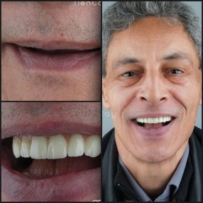 Efekty przed i po implantach jarzmowych w Dentaray Clinic – przywrócony uśmiech