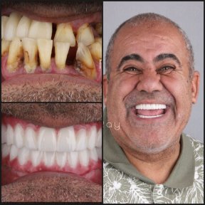 Результаты до и после зигоматических имплантов в Dentaray Clinic – восстановление улыбки