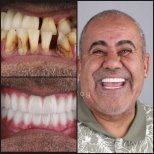 Результаты до и после зигоматических имплантов в Dentaray Clinic – восстановление улыбки