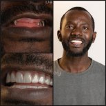 Результаты до и после зигоматических имплантов в Dentaray Clinic – восстановленная улыбка