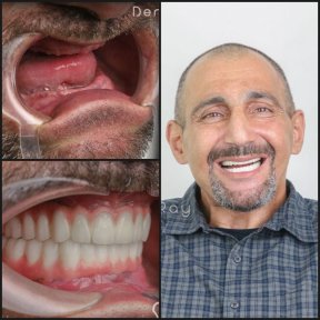 Результаты до и после зигоматических имплантов в Dentaray Clinic – восстановленная улыбка